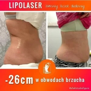lipolaser