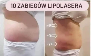 lipolaser