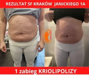 kriolipoliza