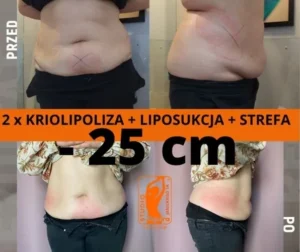 kriolipoliza