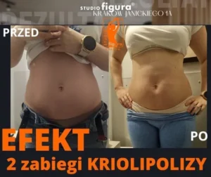 kriolipoliza