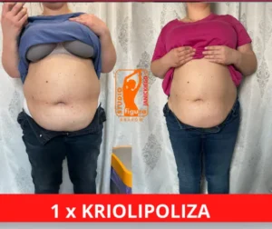 kriolipoliza