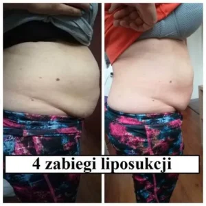 liposukcja