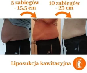 liposukcja